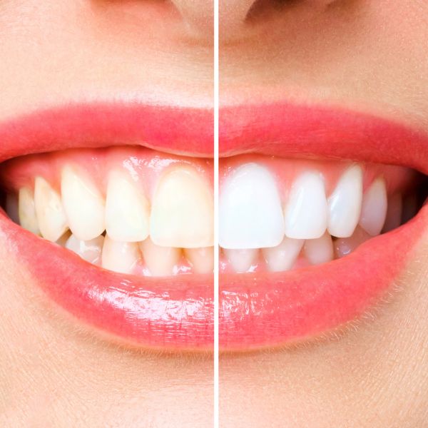 Teeth Whitening Training In-Person Course