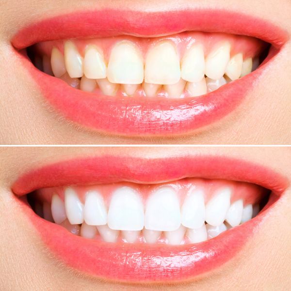Teeth Whitening Training In-Person Course